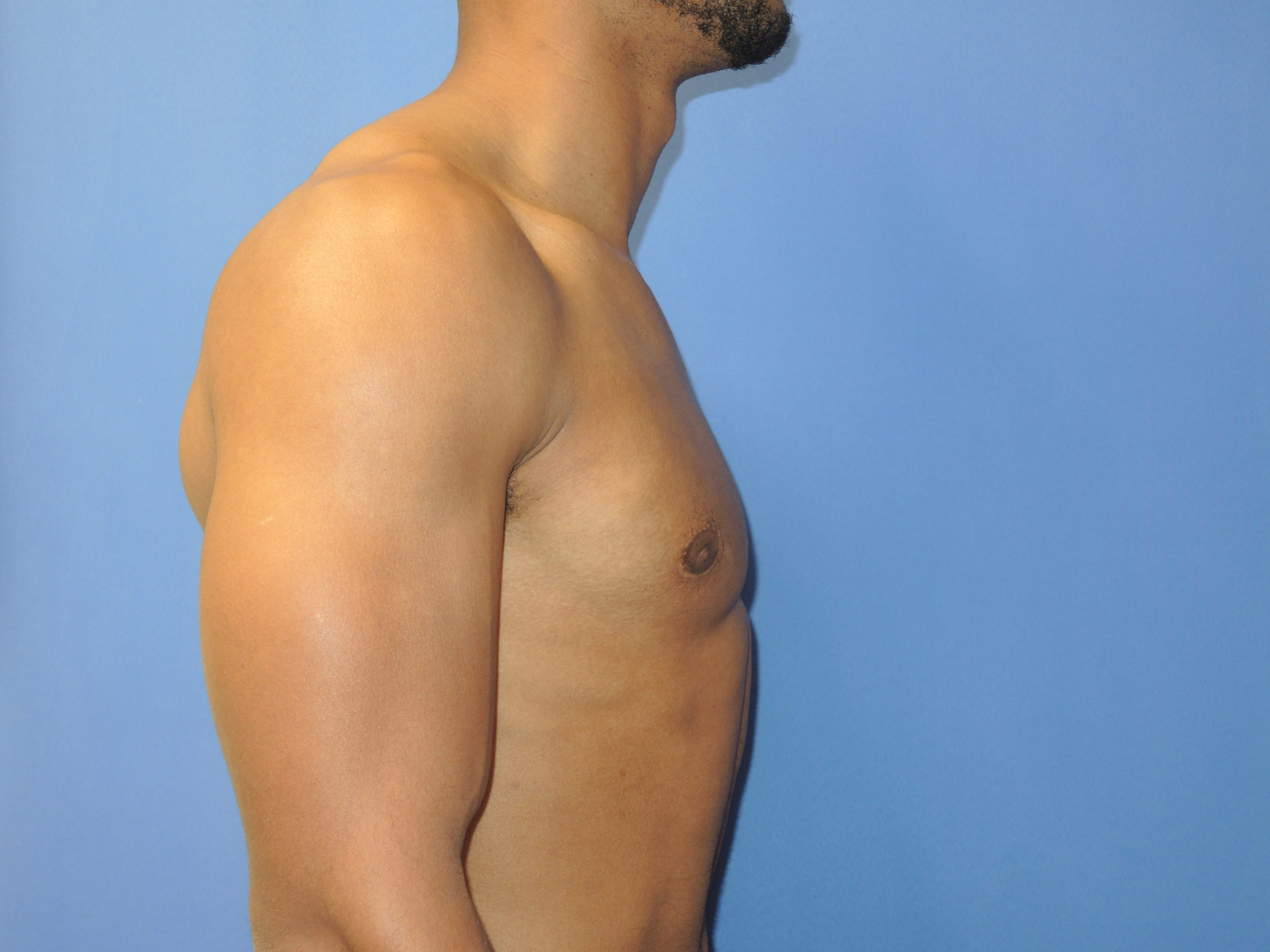 Male Breast Reduction Patient Photo - Case 5053 - after view-3