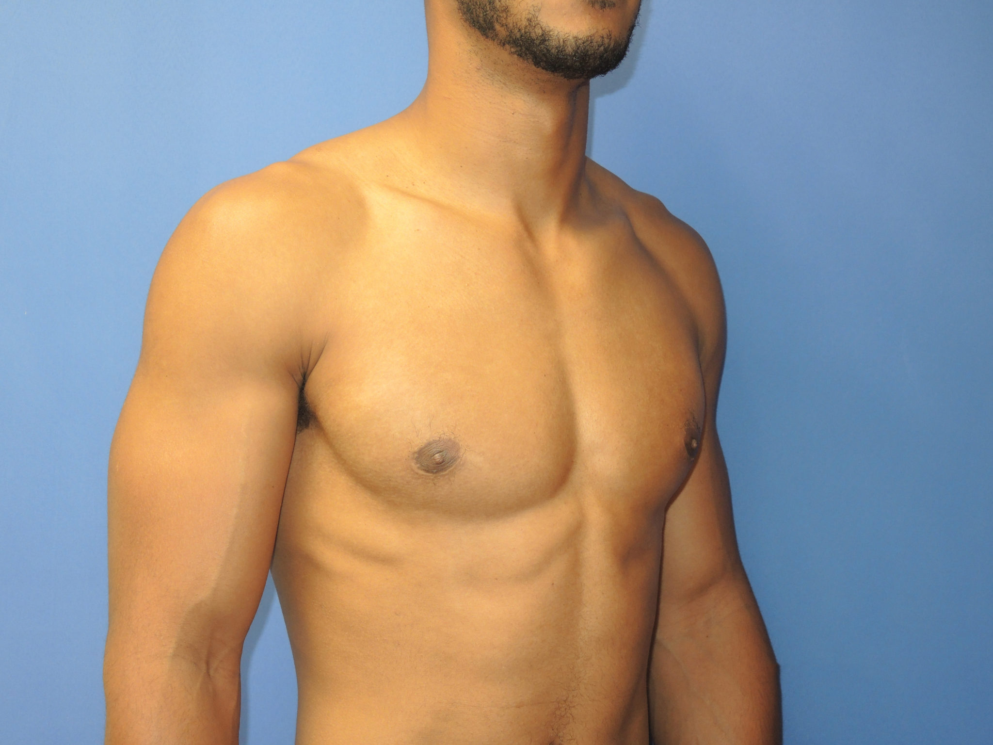 Male Breast Reduction Patient Photo - Case 5053 - after view-4