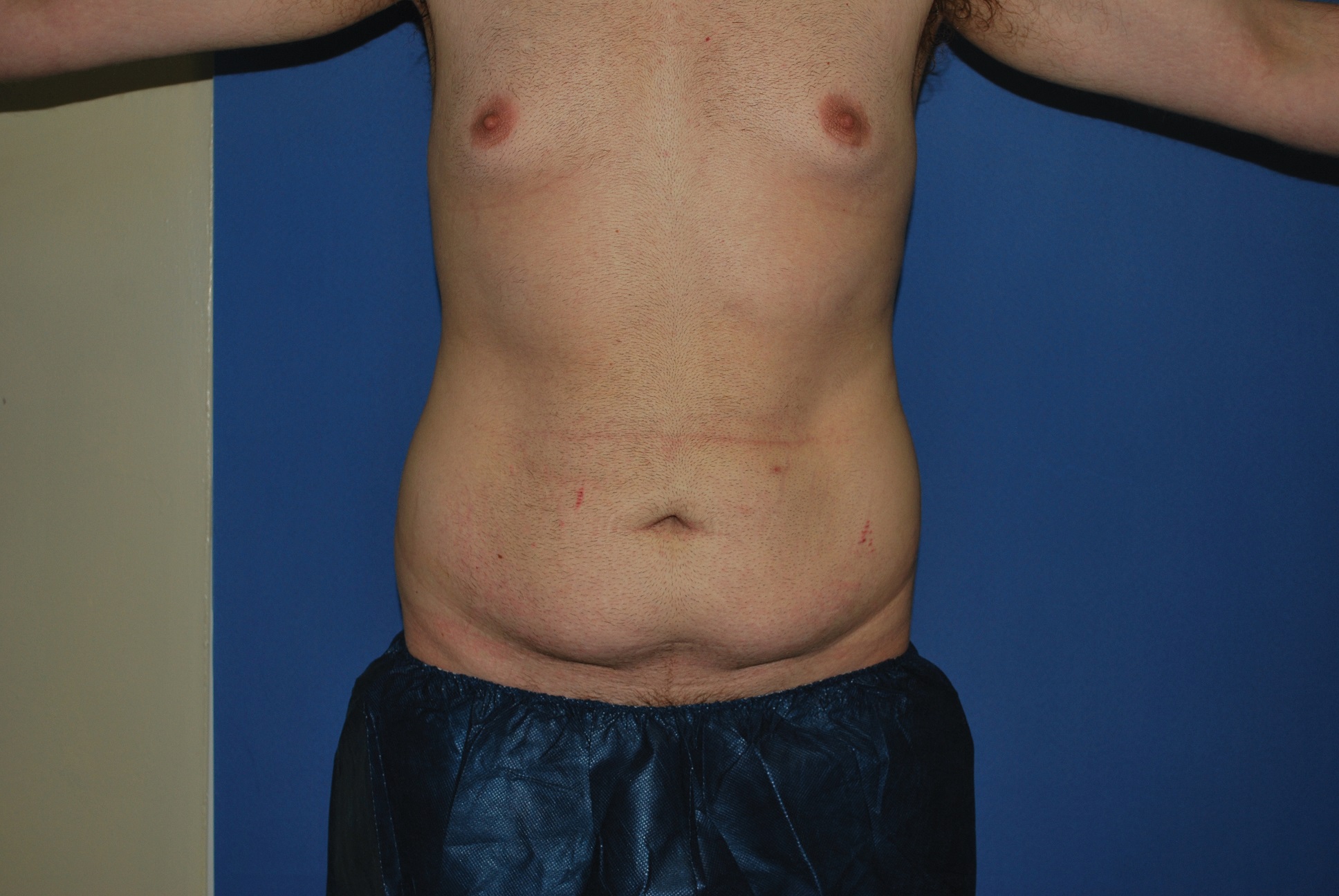 Tummy Tuck Patient Photo - Case 4204 - before view-0