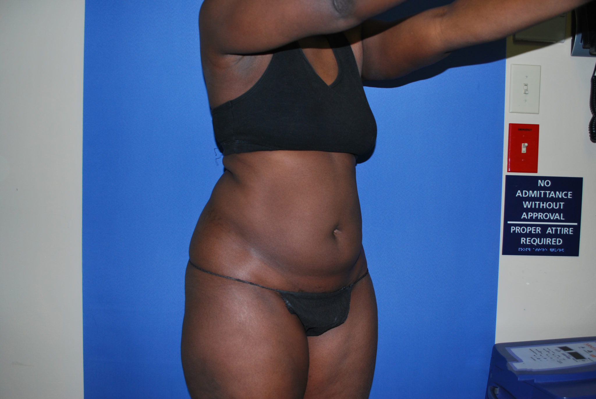 Liposuction Patient Photo - Case 3266 - before view-4