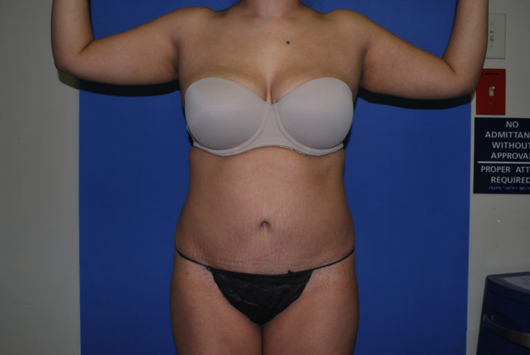 Tummy Tuck - Case 3465 - After