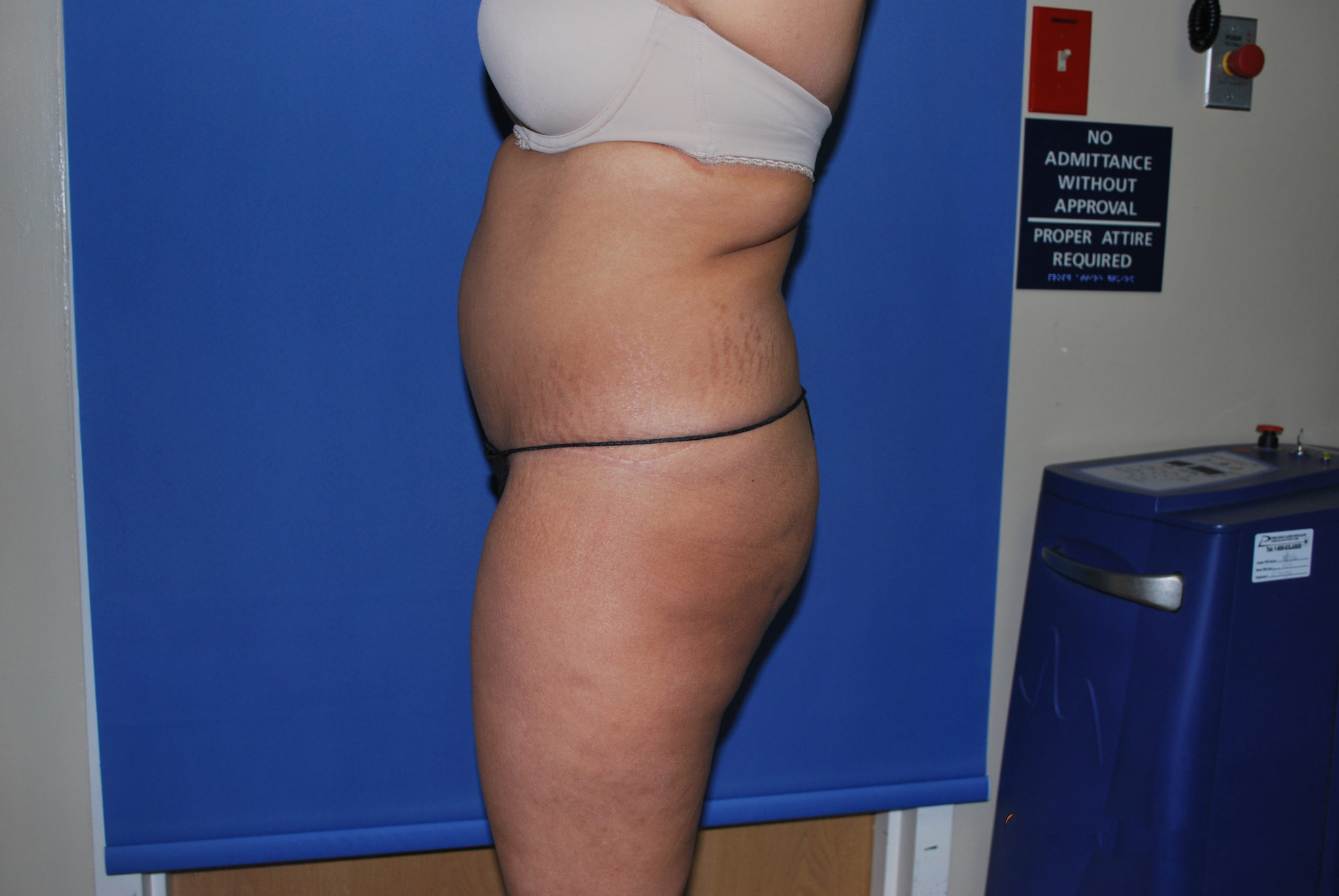 Tummy Tuck Patient Photo - Case 3465 - after view-1