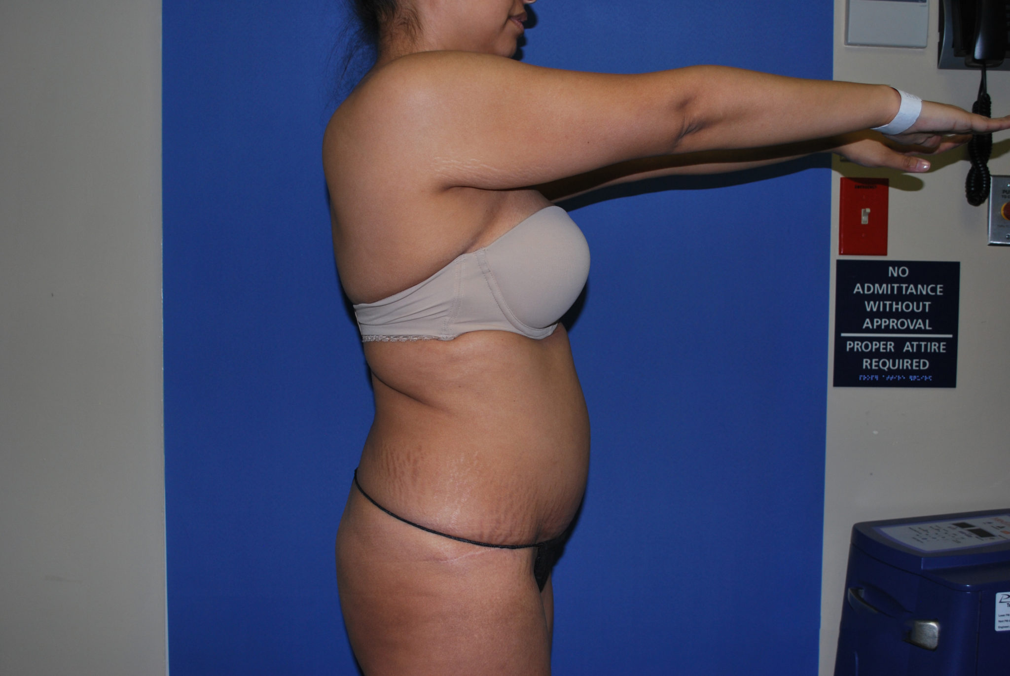 Tummy Tuck Patient Photo - Case 3465 - after view-2