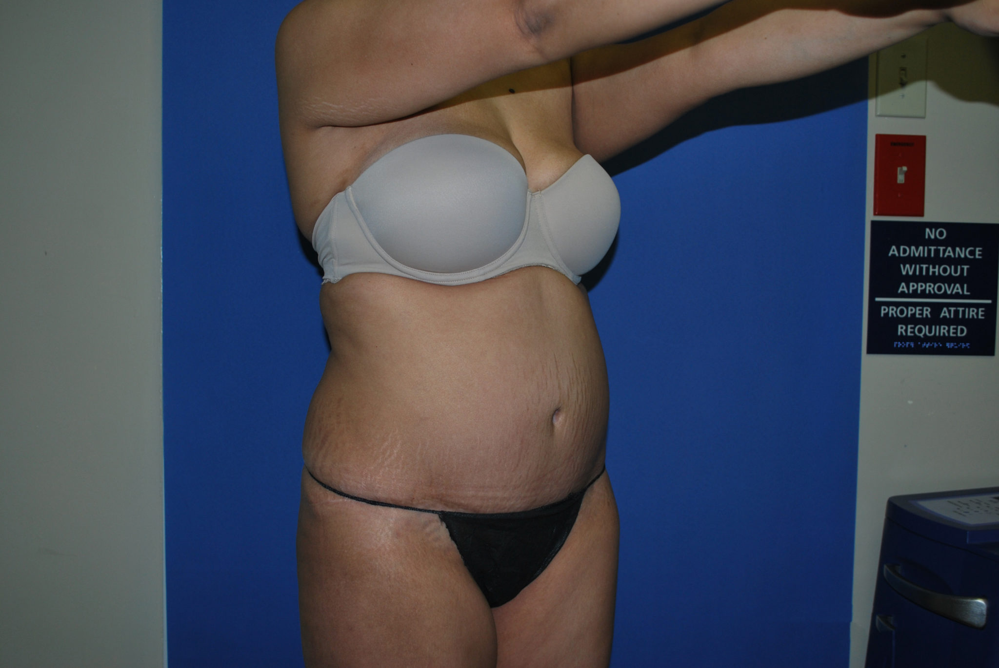 Tummy Tuck Patient Photo - Case 3465 - after view-4