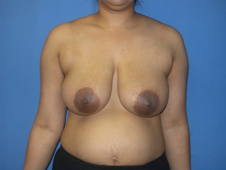 Breast Reduction - Case 4421 - Before