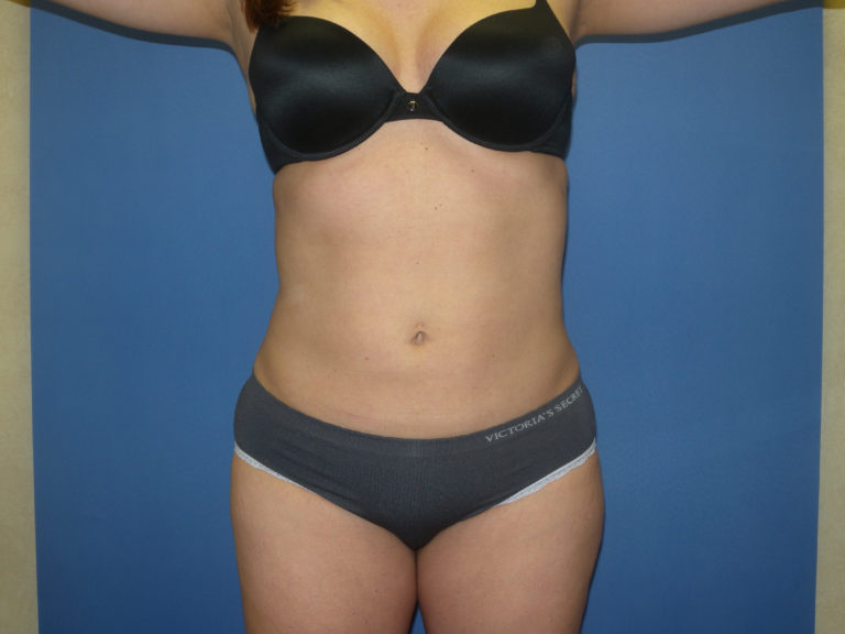 Liposuction - Case 3259 - After