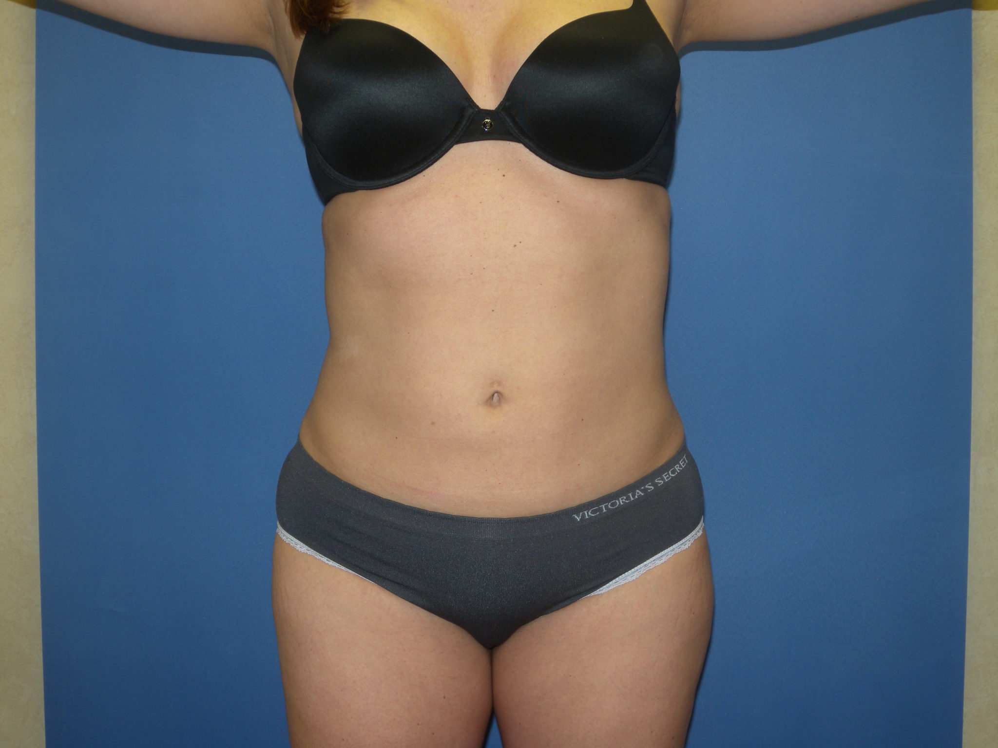 Liposuction Patient Photo - Case 3259 - after view