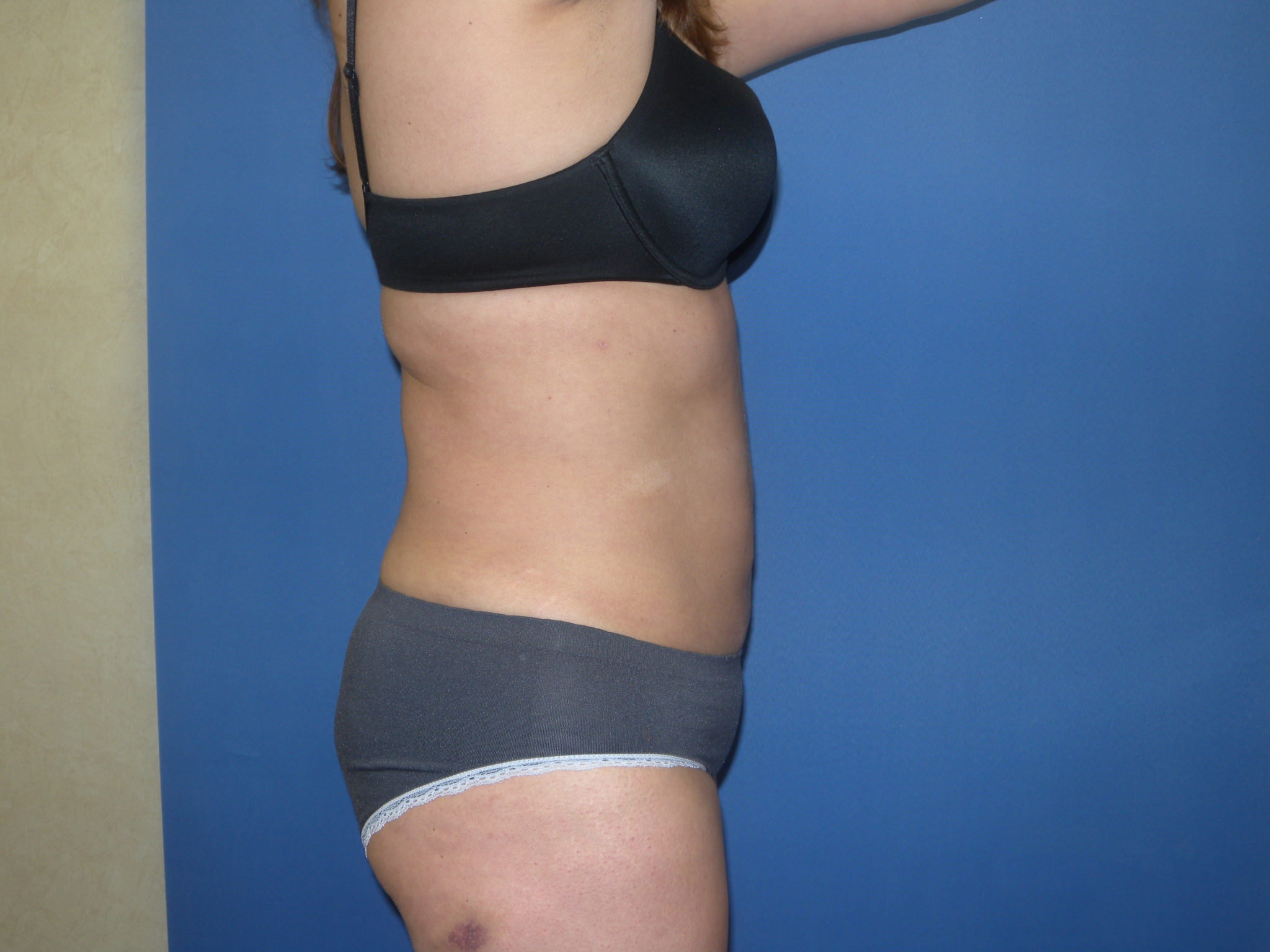 Liposuction Patient Photo - Case 3259 - after view-2