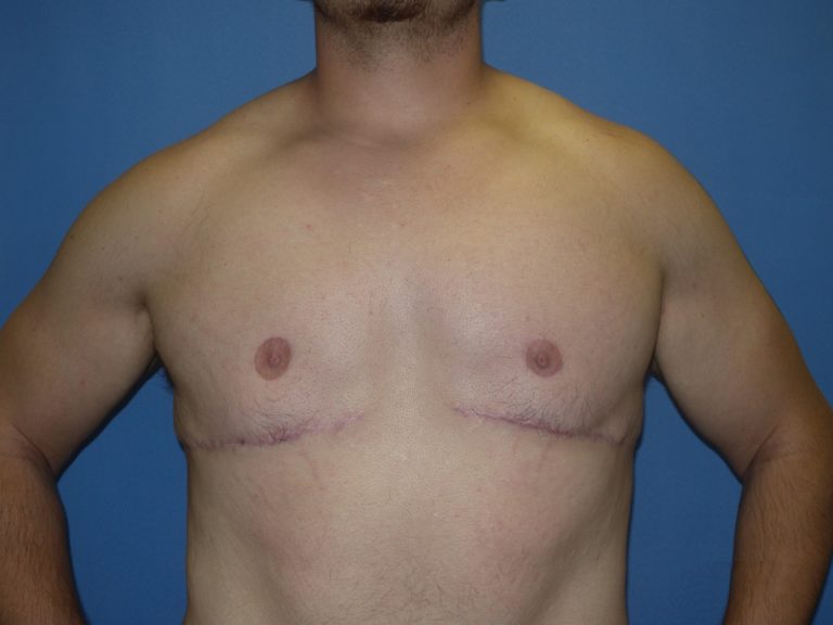 Male Breast Reduction - Case 4198 - After