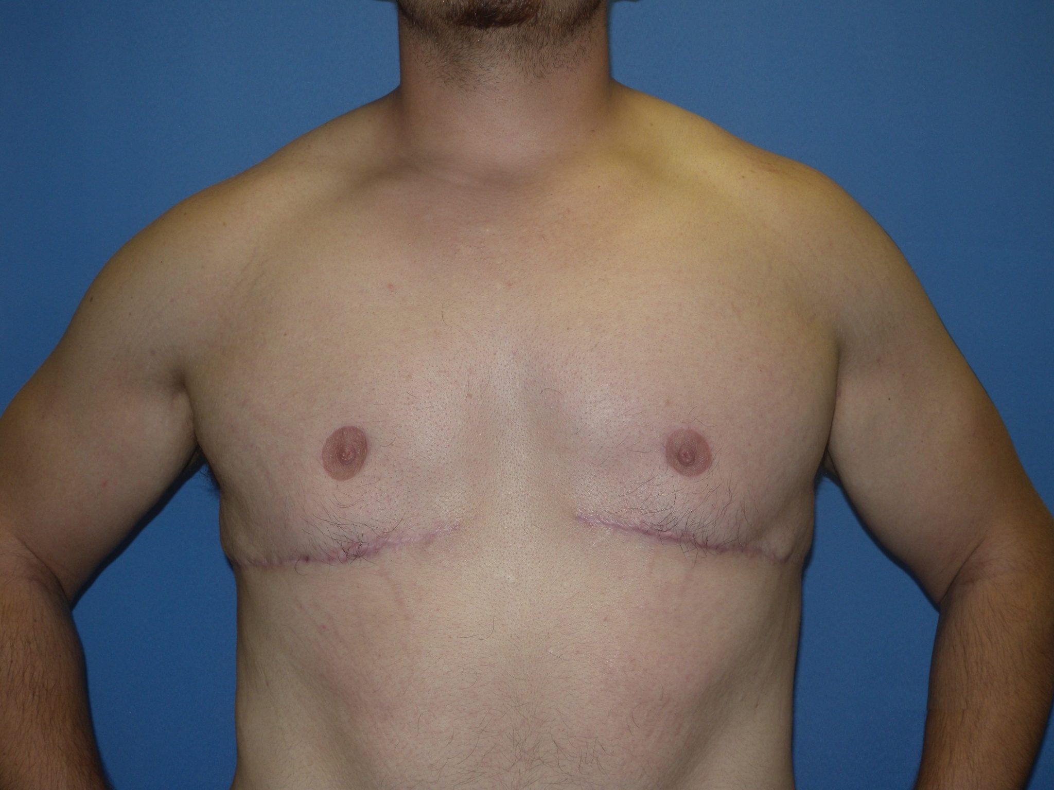 Male Breast Reduction Patient Photo - Case 4198 - after view-0