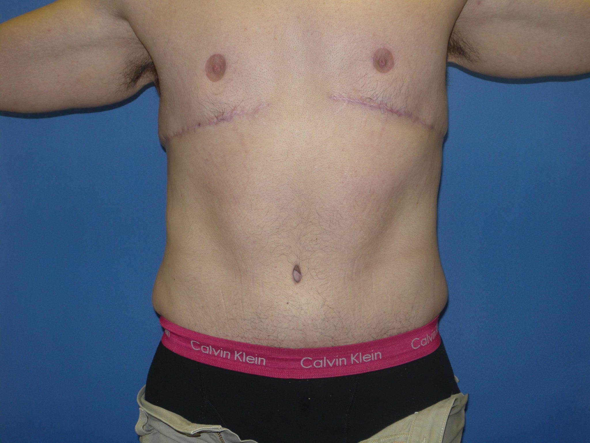 Male Breast Reduction Patient Photo - Case 4198 - after view-1