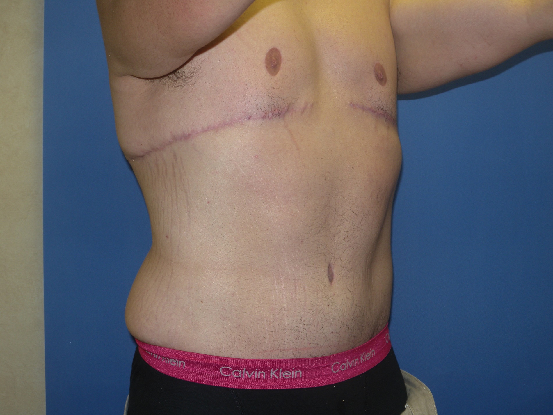Male Breast Reduction Patient Photo - Case 4198 - after view-5