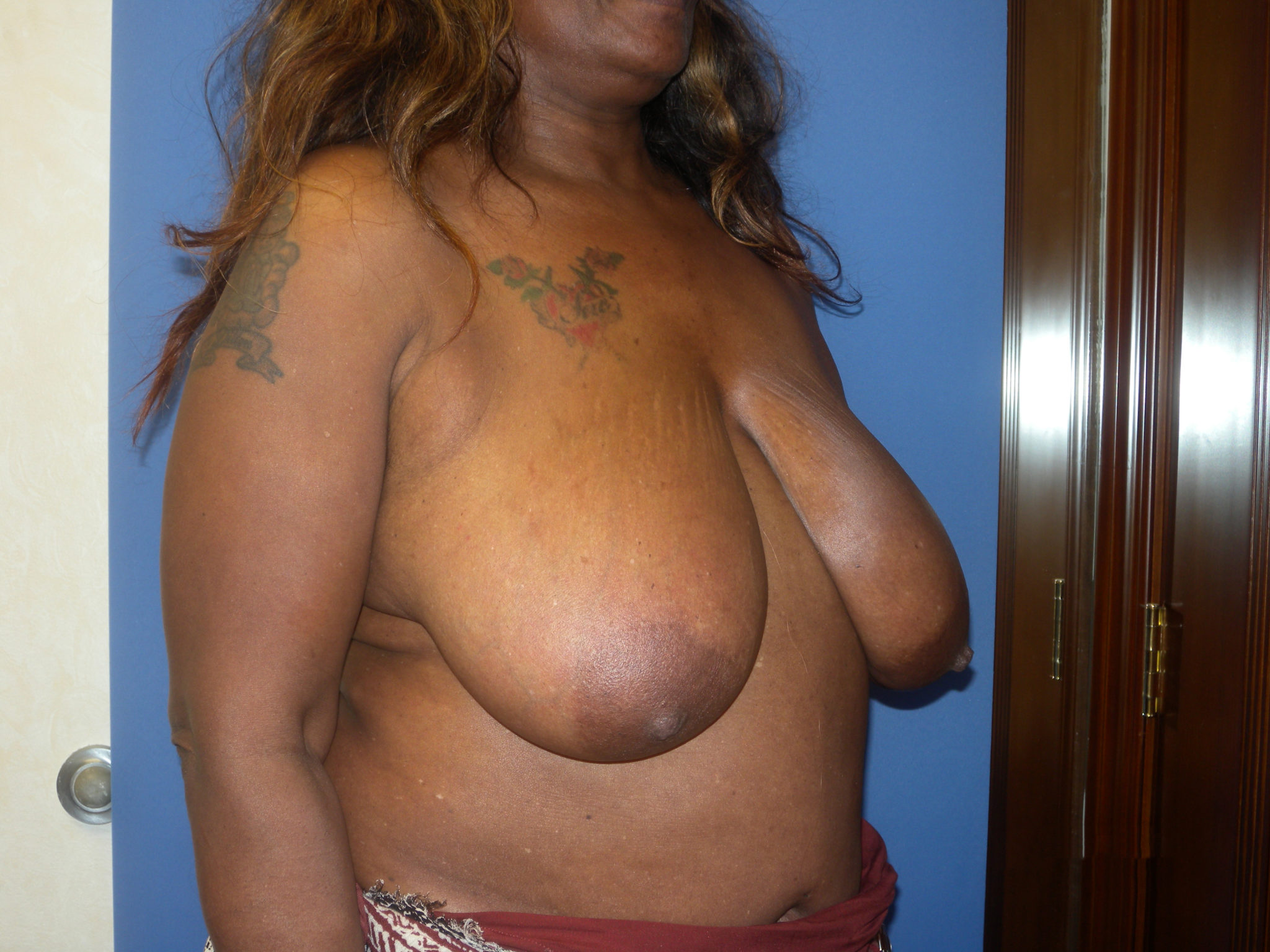 Breast Reduction Patient Photo - Case 4537 - before view-2