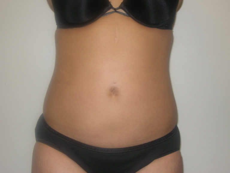 Liposuction - Case 3058 - After
