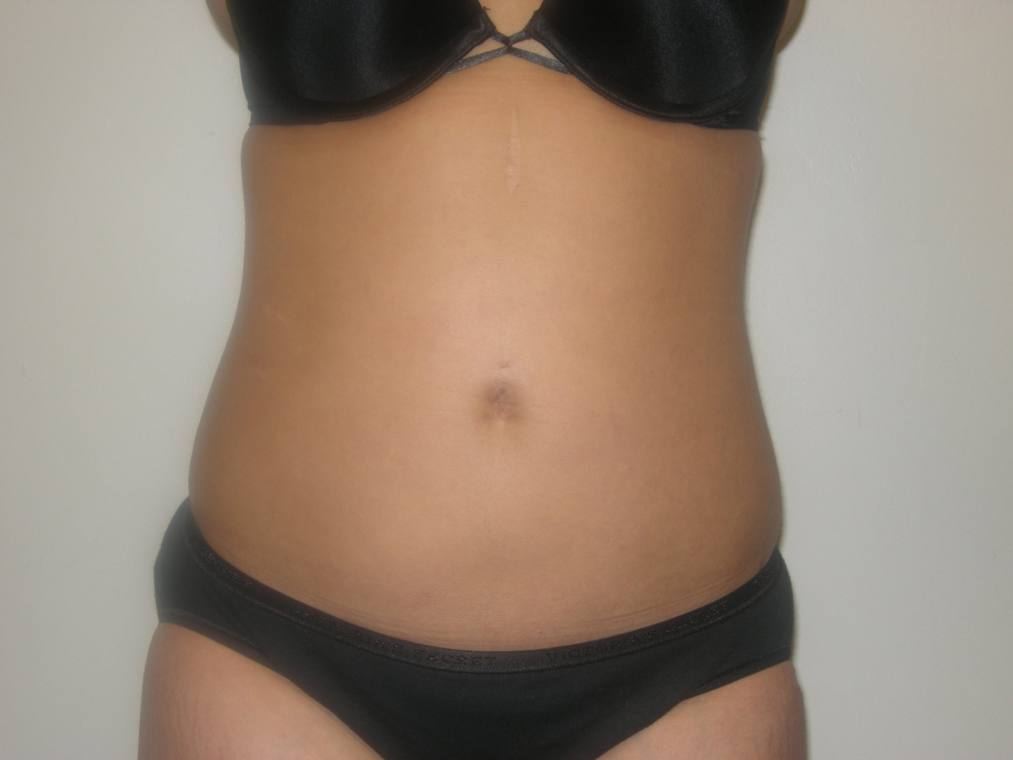 Liposuction Patient Photo - Case 3058 - after view-0