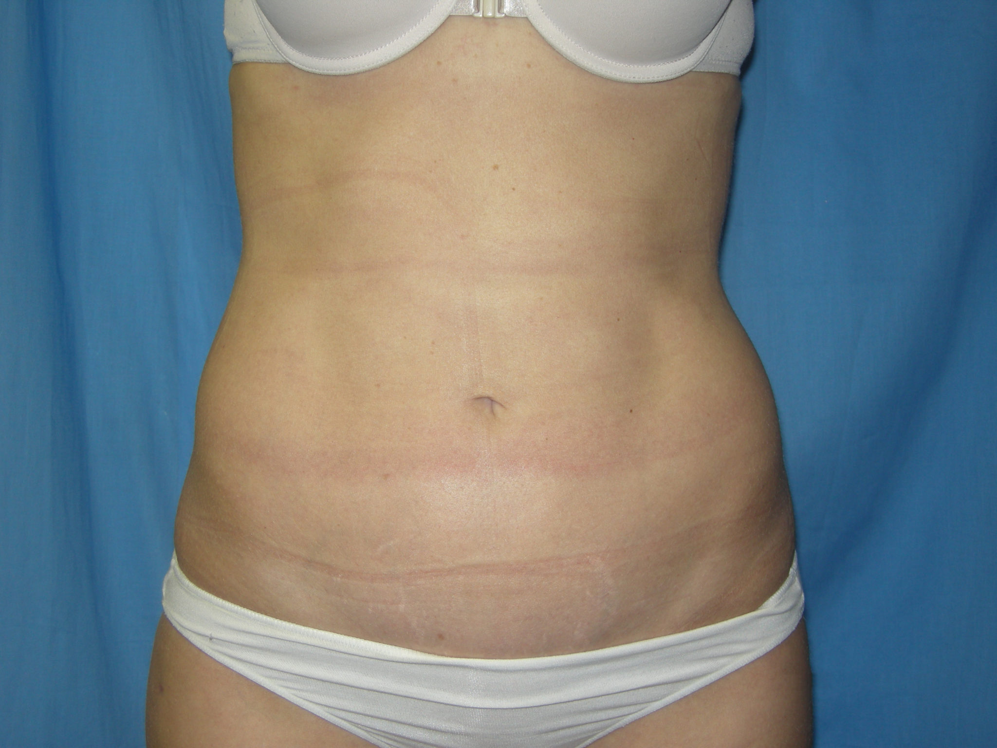 Liposuction Patient Photo - Case 3348 - after view