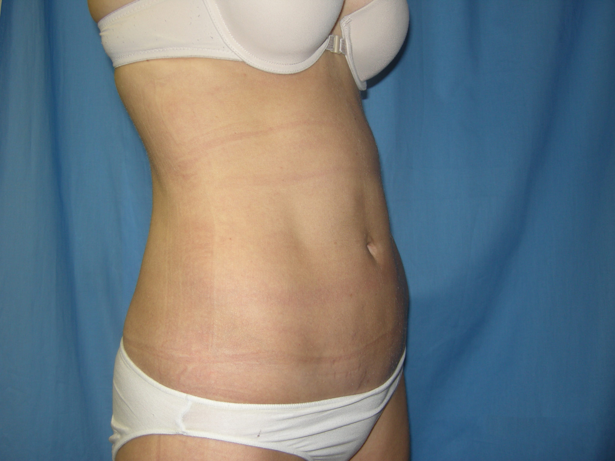 Liposuction Patient Photo - Case 3348 - after view-2