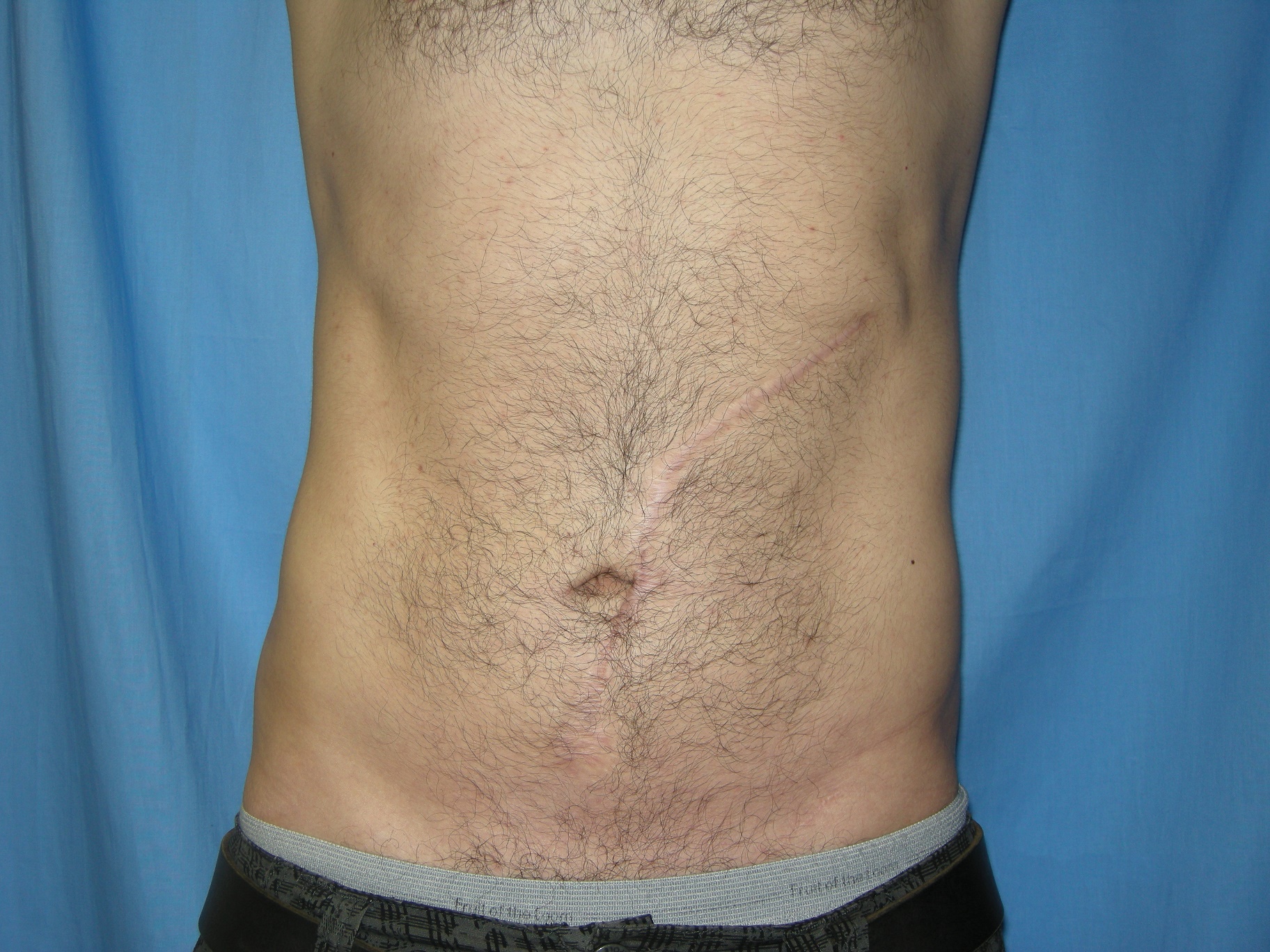 Liposuction Patient Photo - Case 4706 - after view-0