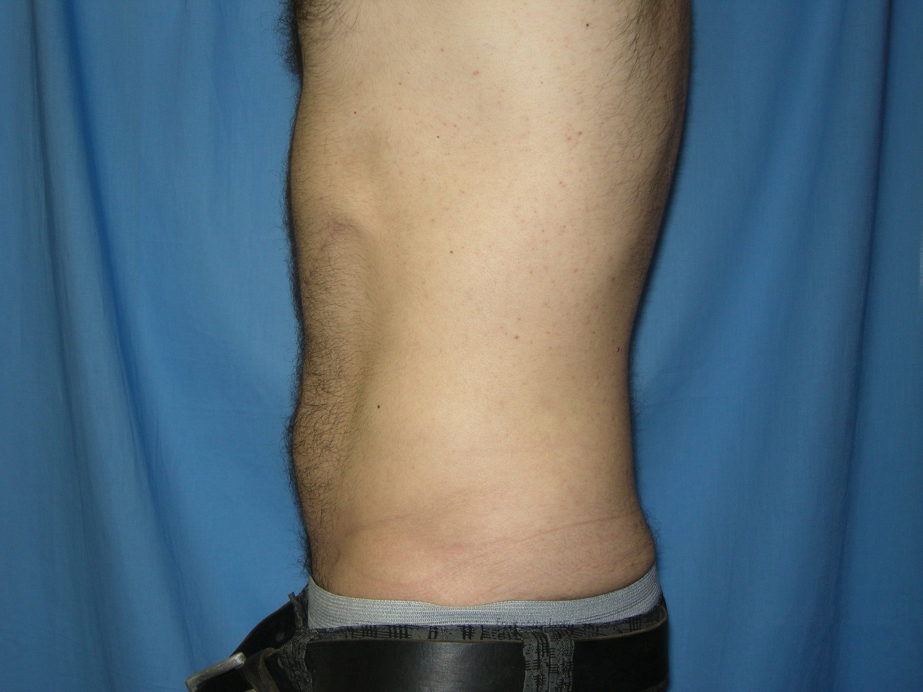 Liposuction Patient Photo - Case 4706 - after view-1