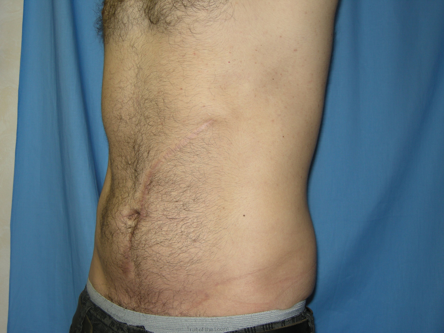 Liposuction Patient Photo - Case 4706 - after view-2