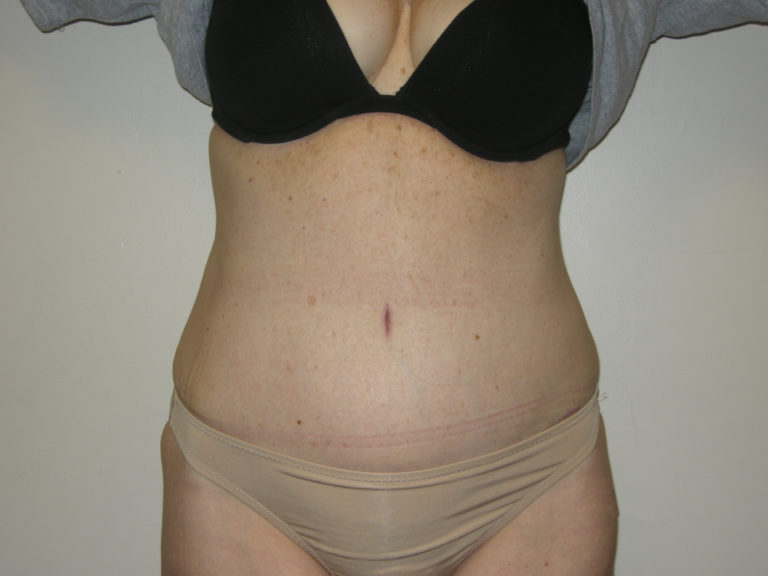 Tummy Tuck - Case 3454 - After