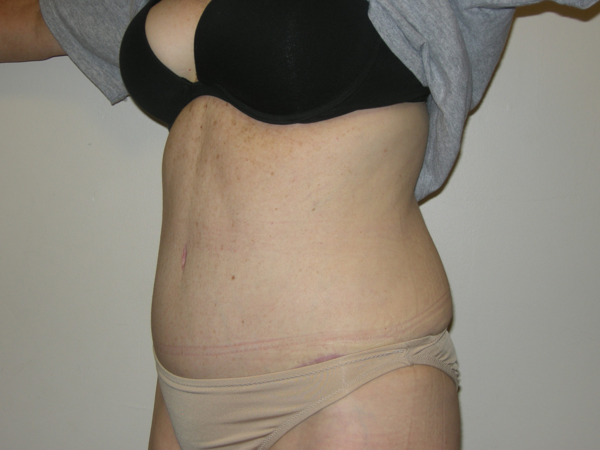 Tummy Tuck Patient Photo - Case 3454 - after view-2