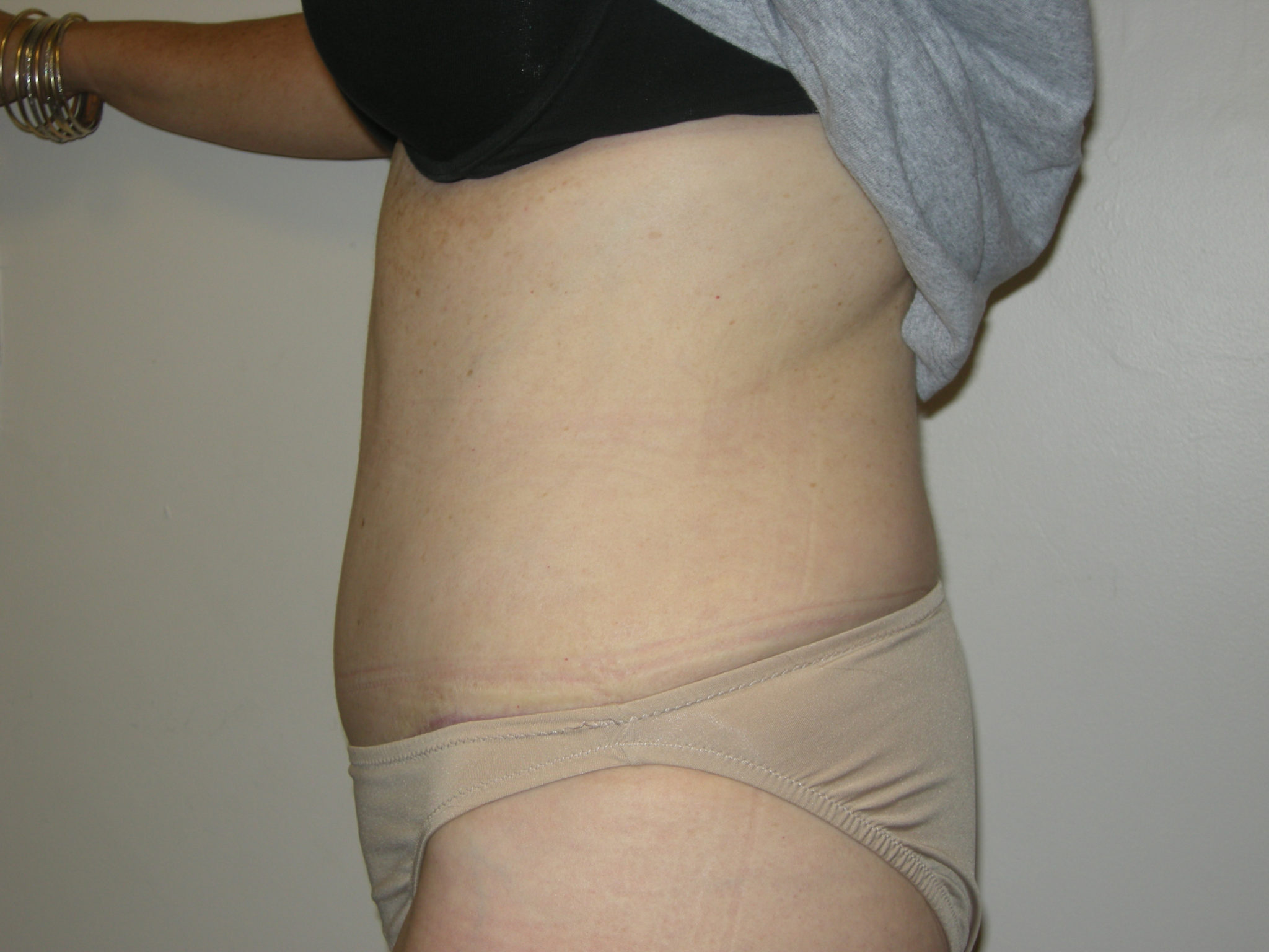 Tummy Tuck Patient Photo - Case 3454 - after view-1