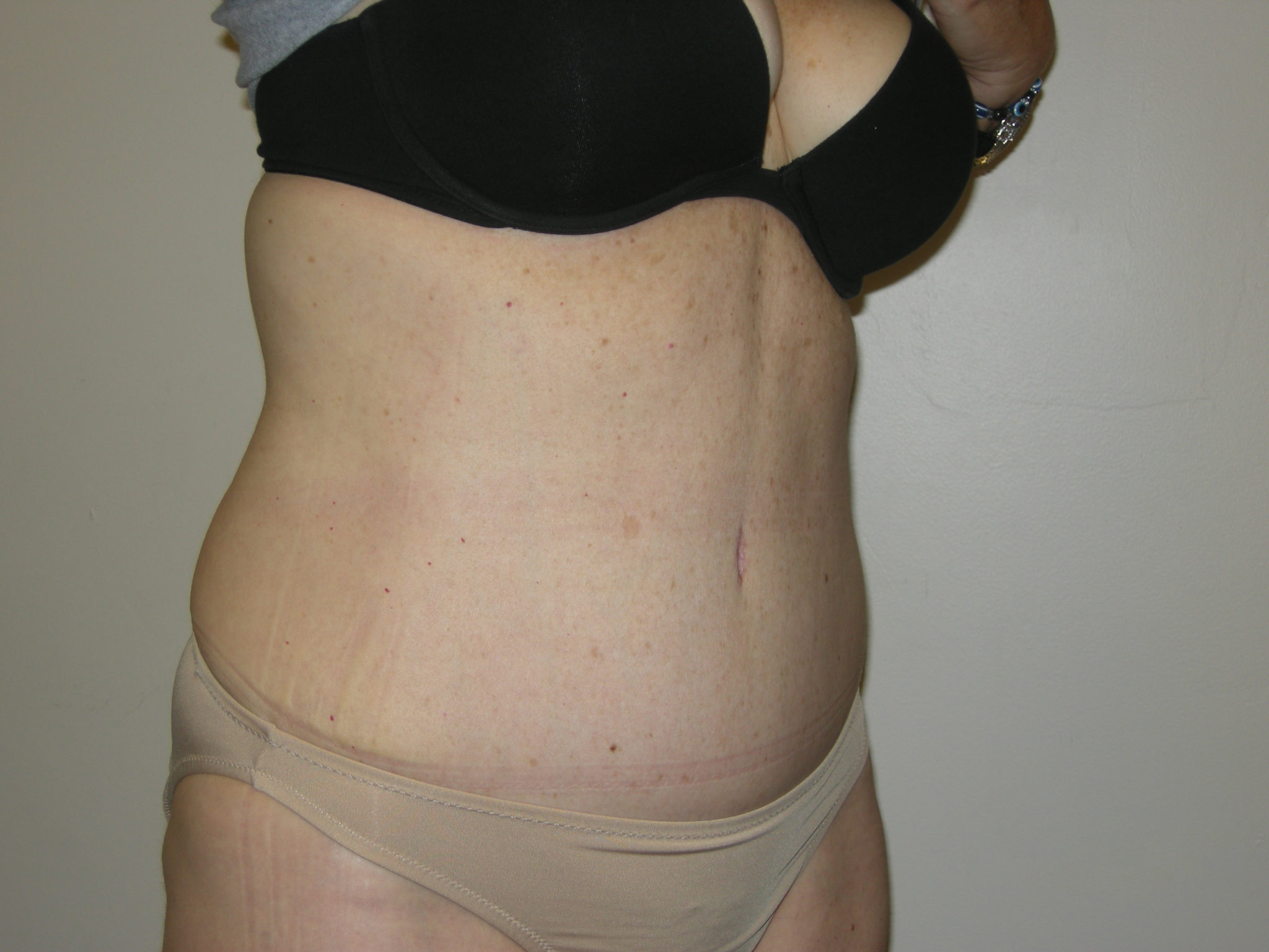 Tummy Tuck Patient Photo - Case 3454 - after view-4