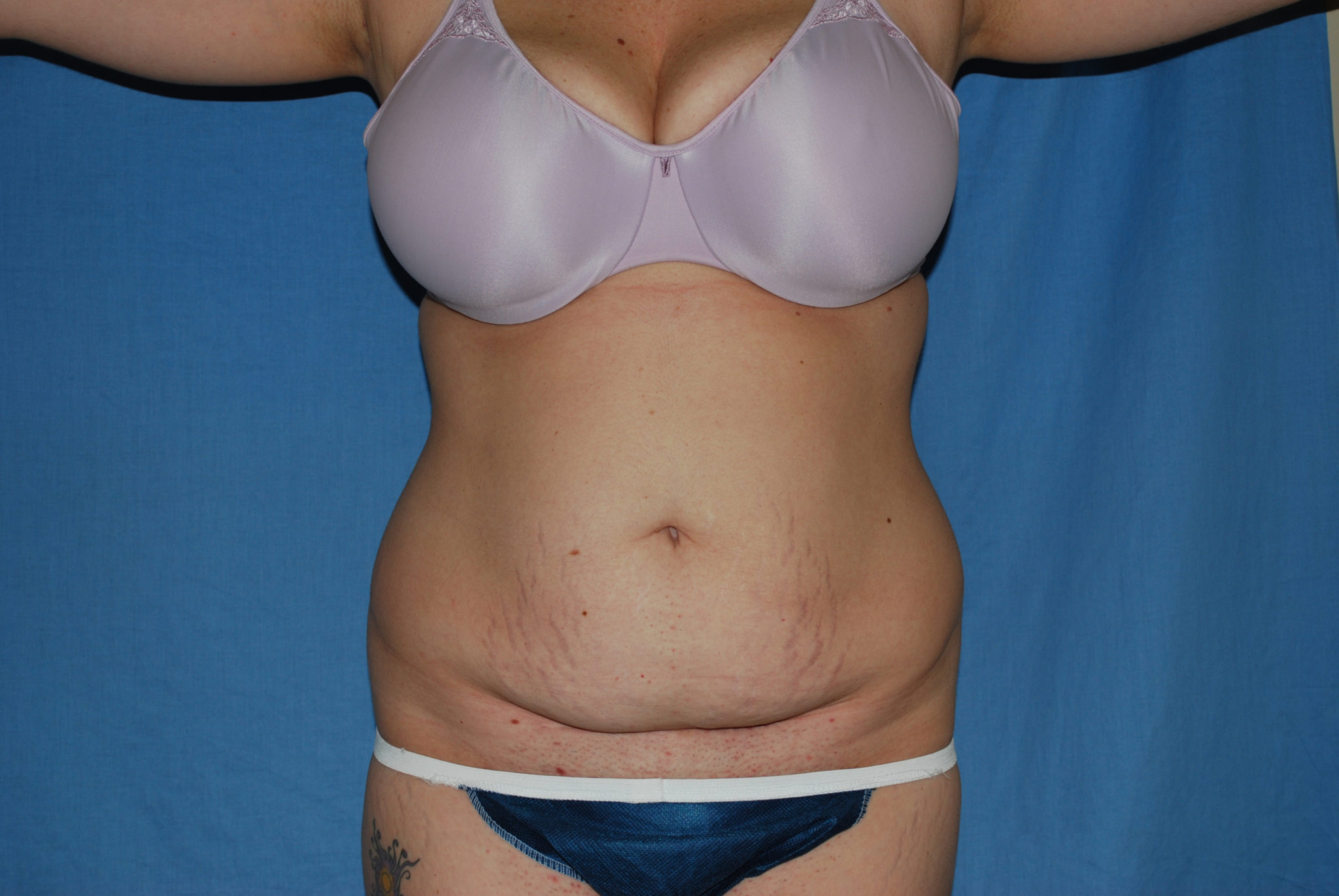Tummy Tuck Patient Photo - Case 3332 - before view-