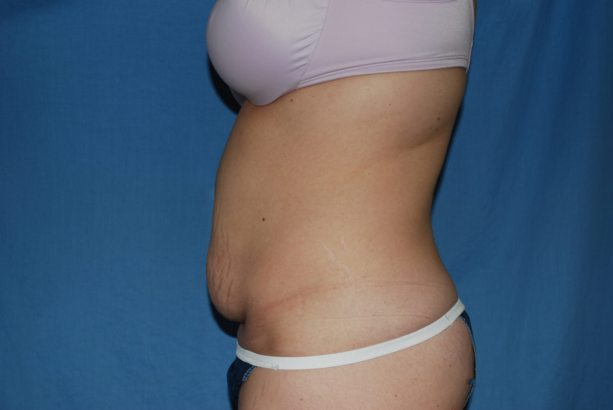 Tummy Tuck Patient Photo - Case 3332 - before view-1
