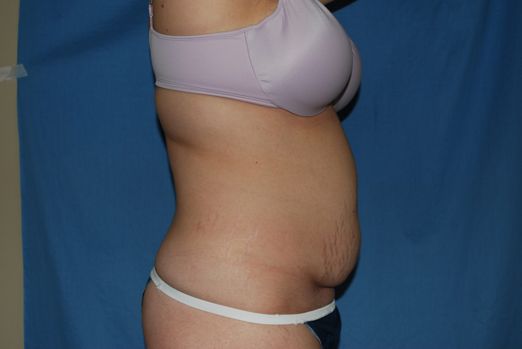 Tummy Tuck Patient Photo - Case 3332 - before view-3