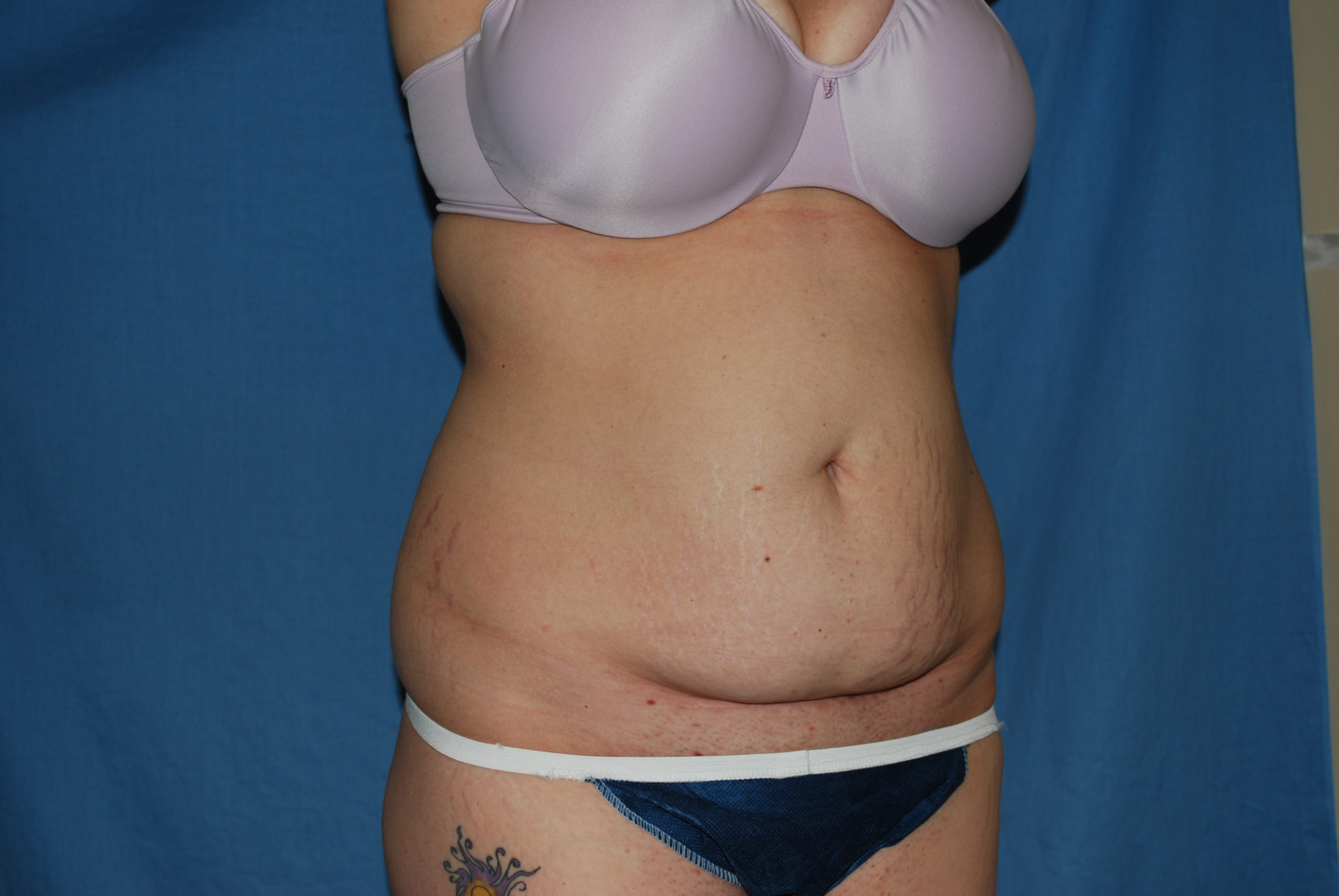 Tummy Tuck Patient Photo - Case 3332 - before view-4