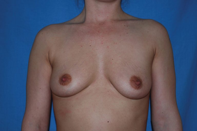 Breast Augmentation - Case 4332 - Before