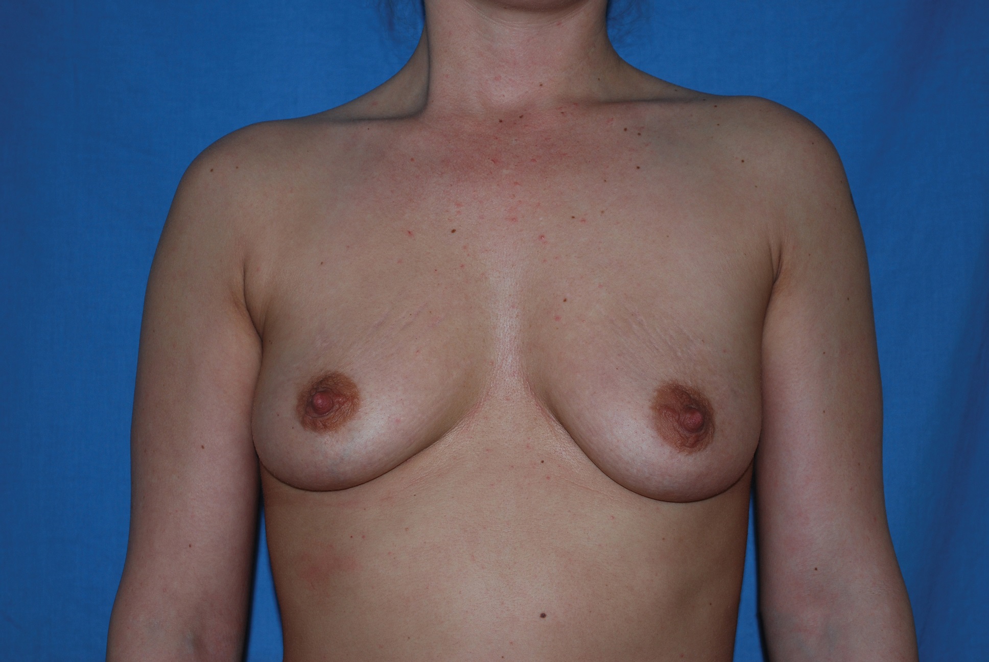 Breast Augmentation Patient Photo - Case 4332 - before view-