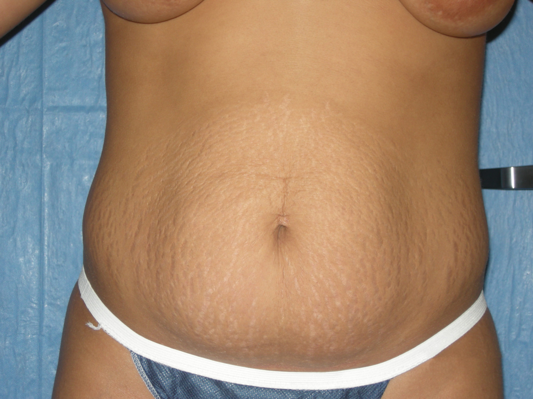 Liposuction Patient Photo - Case 3443 - before view-