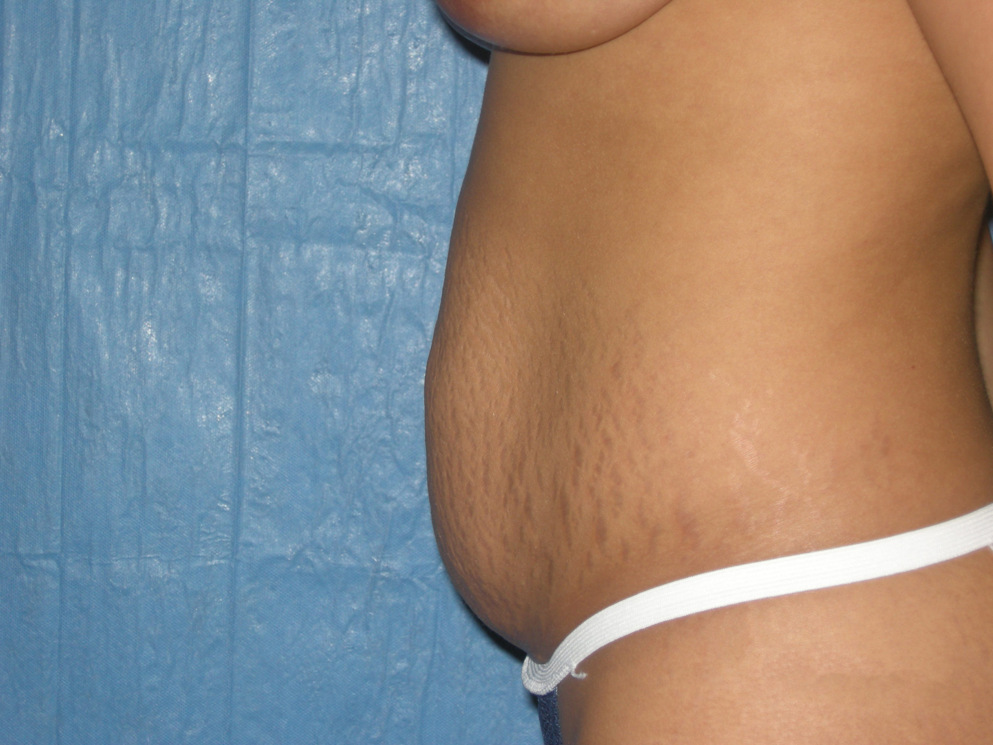 Liposuction Patient Photo - Case 3443 - before view-1