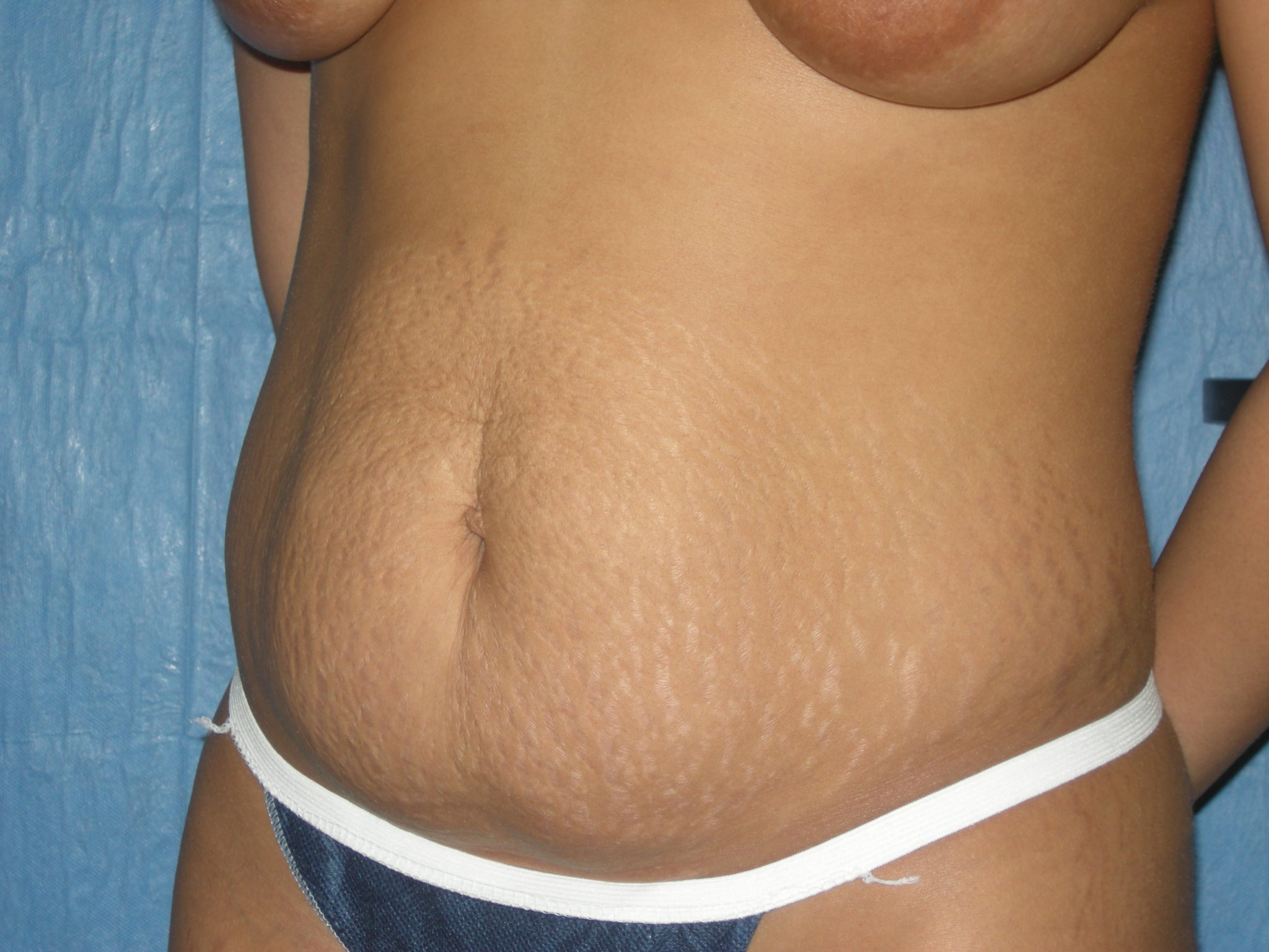 Liposuction Patient Photo - Case 3443 - before view-2