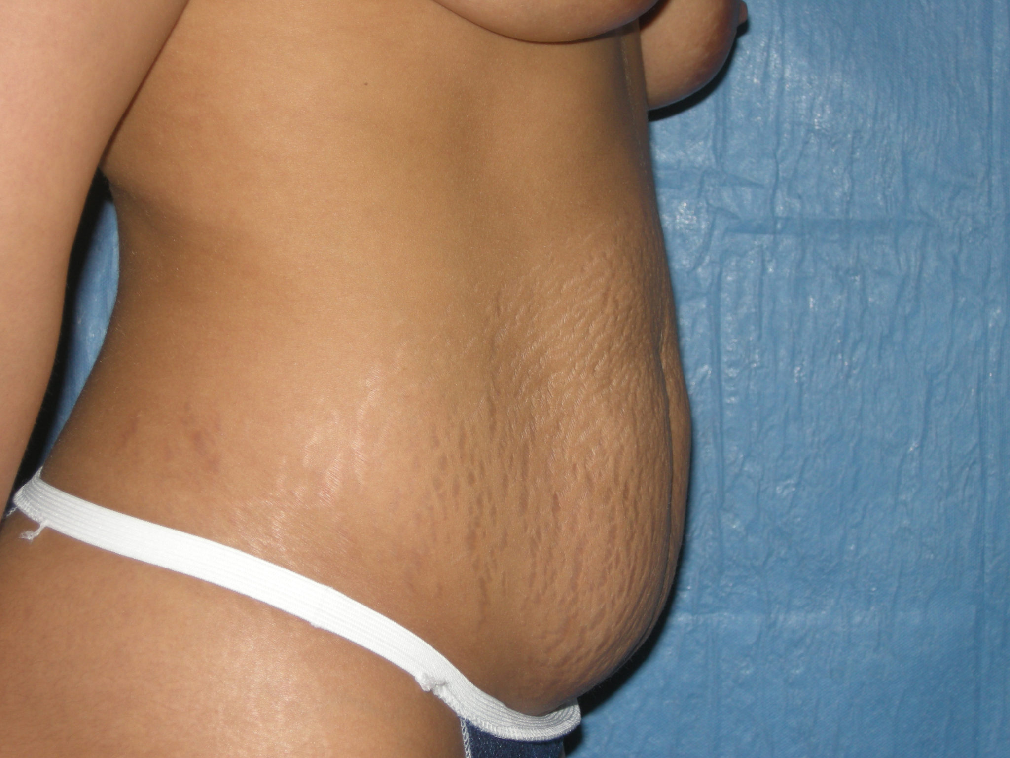 Liposuction Patient Photo - Case 3443 - before view-3