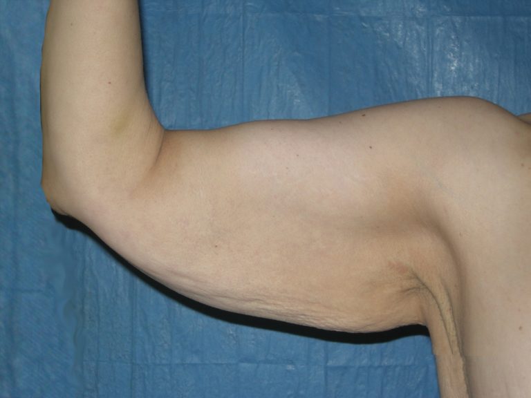 Arm Lift - Case 4223 - Before