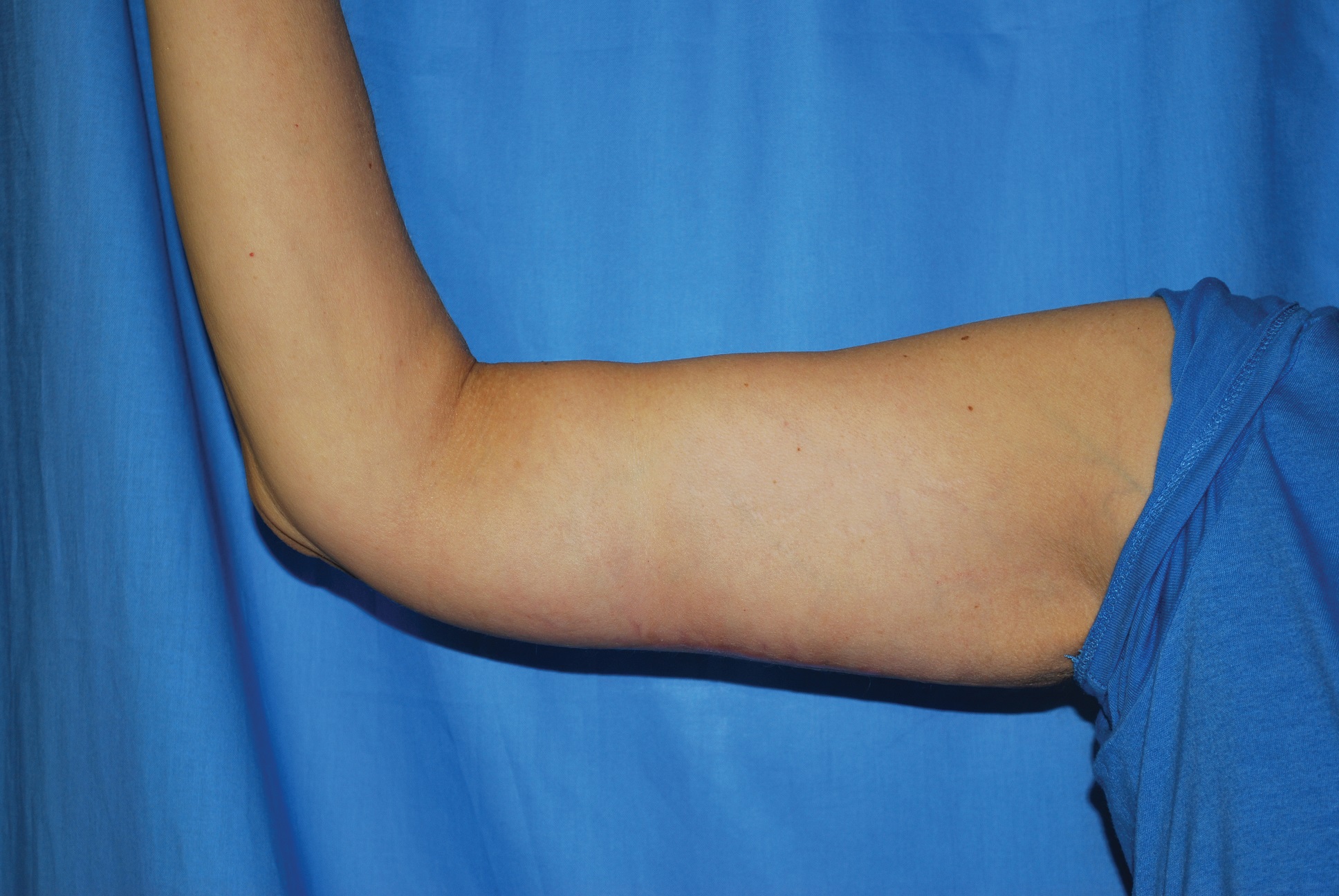 Arm Lift Patient Photo - Case 4223 - after view