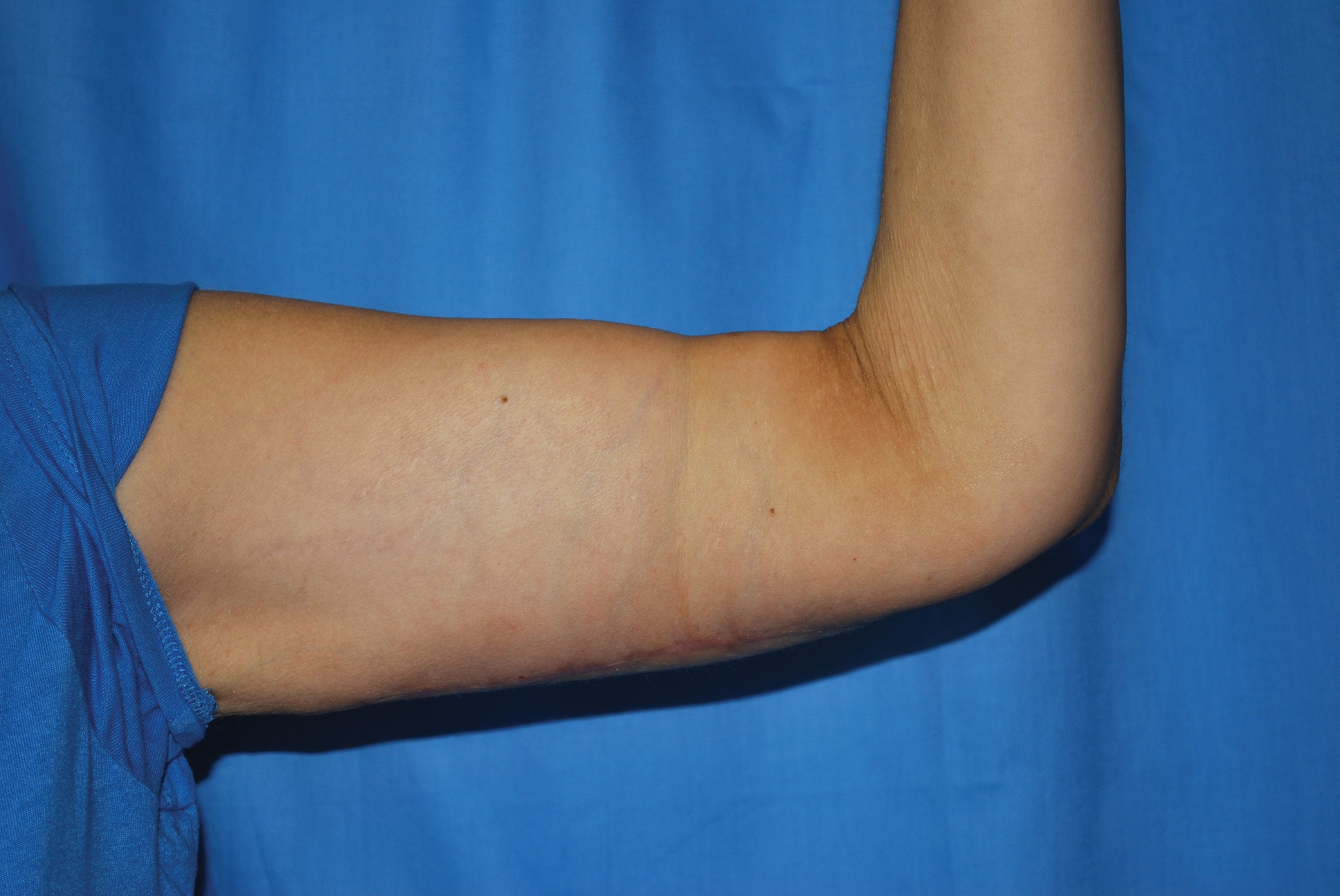 Arm Lift Patient Photo - Case 4223 - after view-1