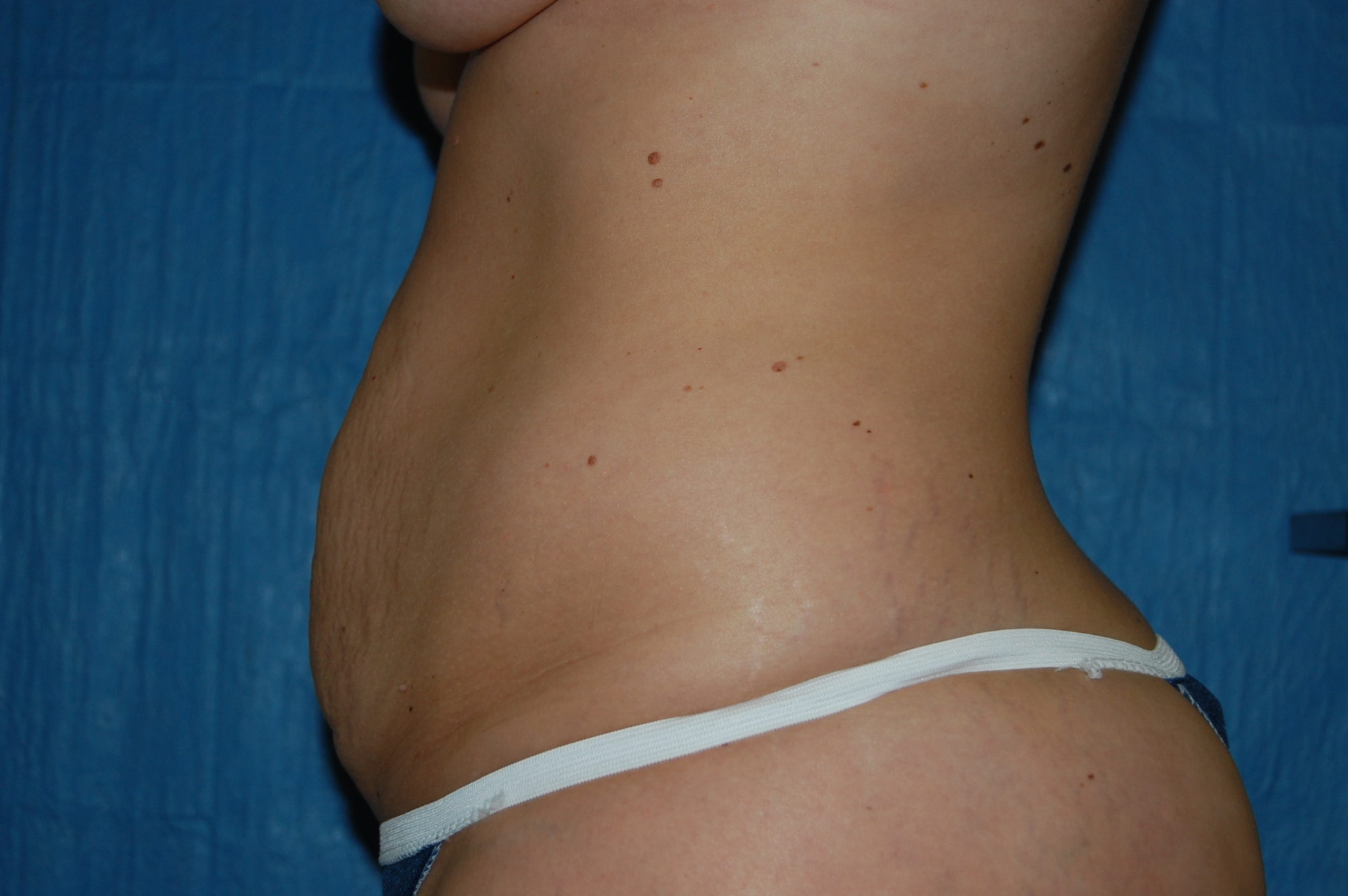 Liposuction Patient Photo - Case 3476 - before view-1