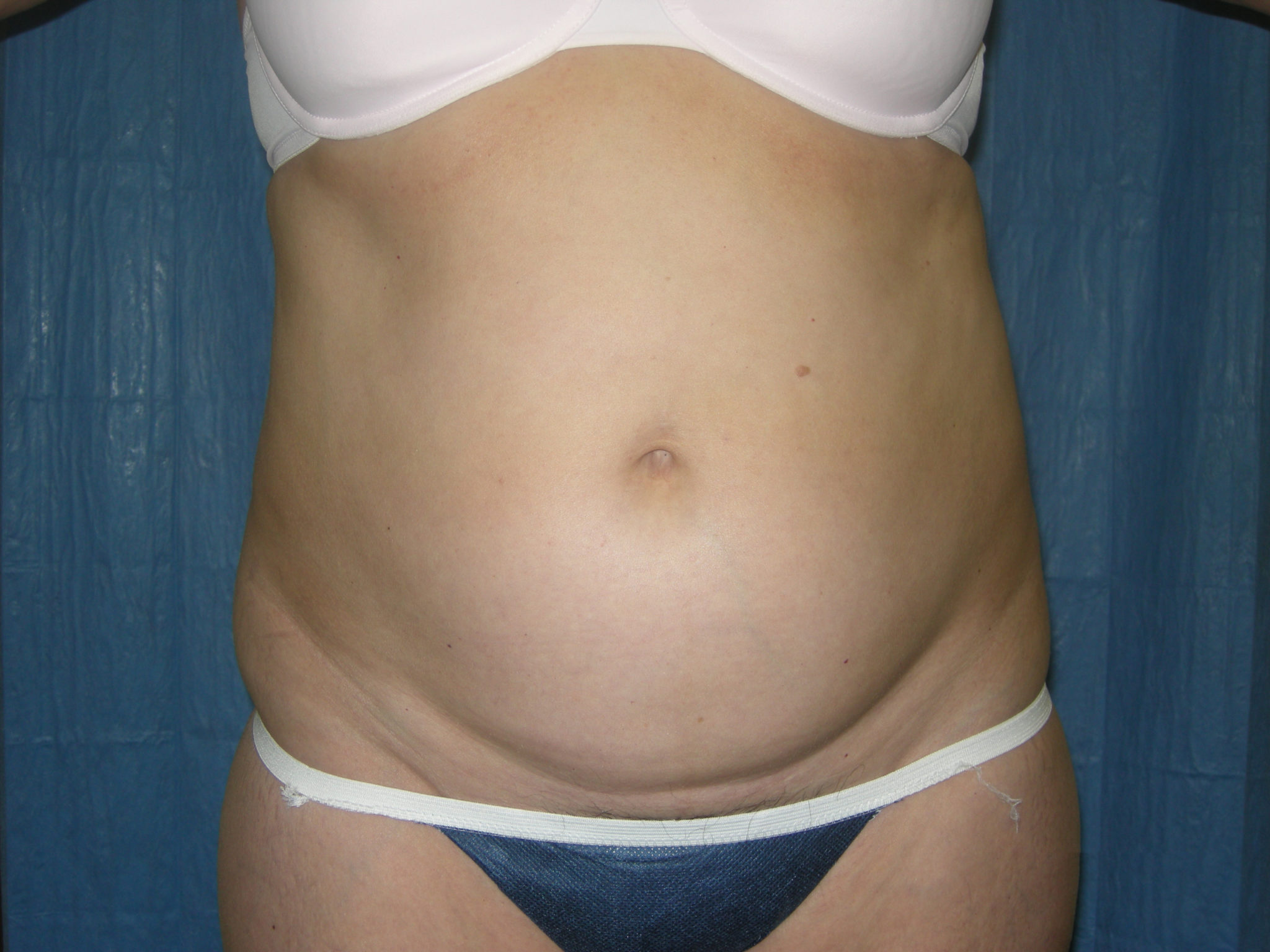 Liposuction Patient Photo - Case 3217 - before view-0