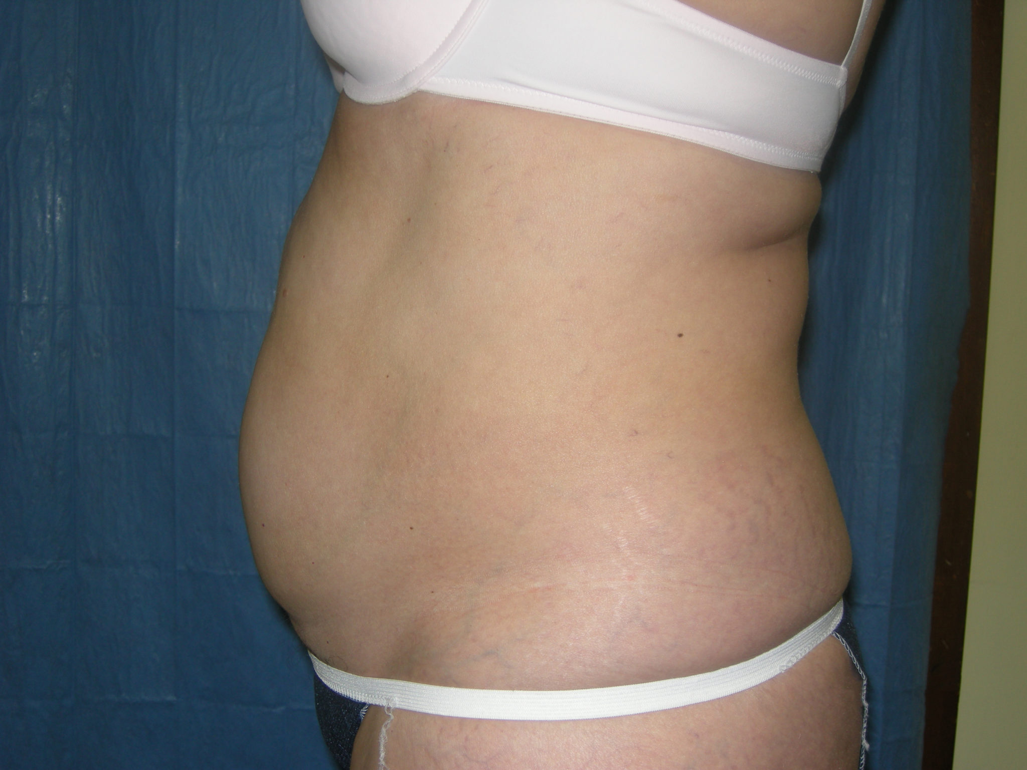 Liposuction Patient Photo - Case 3217 - before view-1