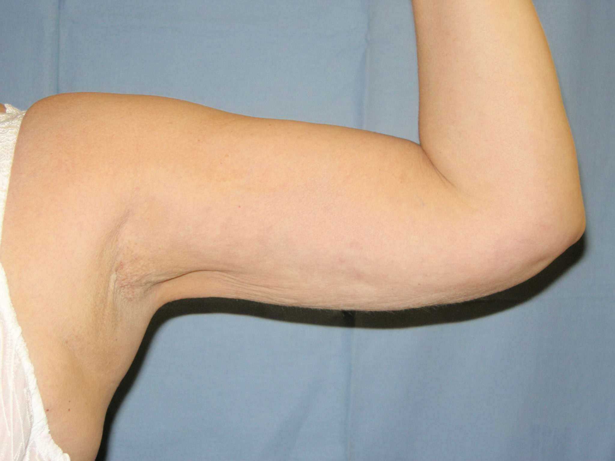 Liposuction Patient Photo - Case 3217 - after view-3