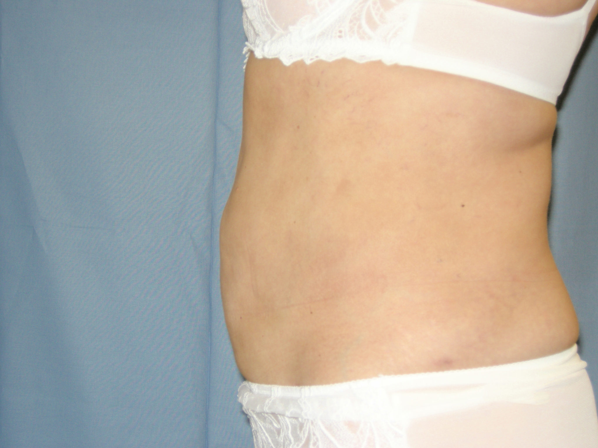 Liposuction Patient Photo - Case 3217 - after view-1