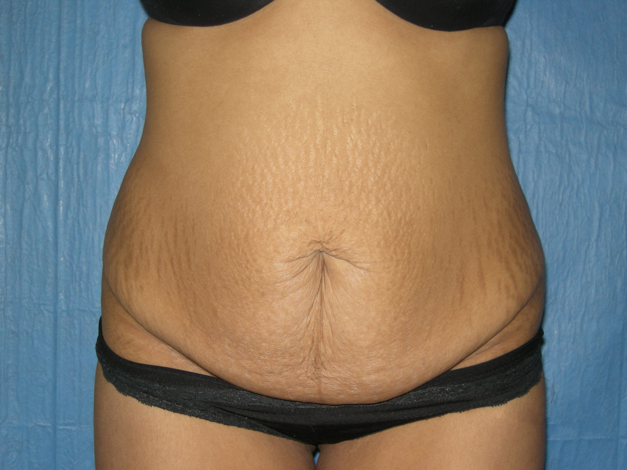 Tummy Tuck Patient Photo - Case 3465 - before view-