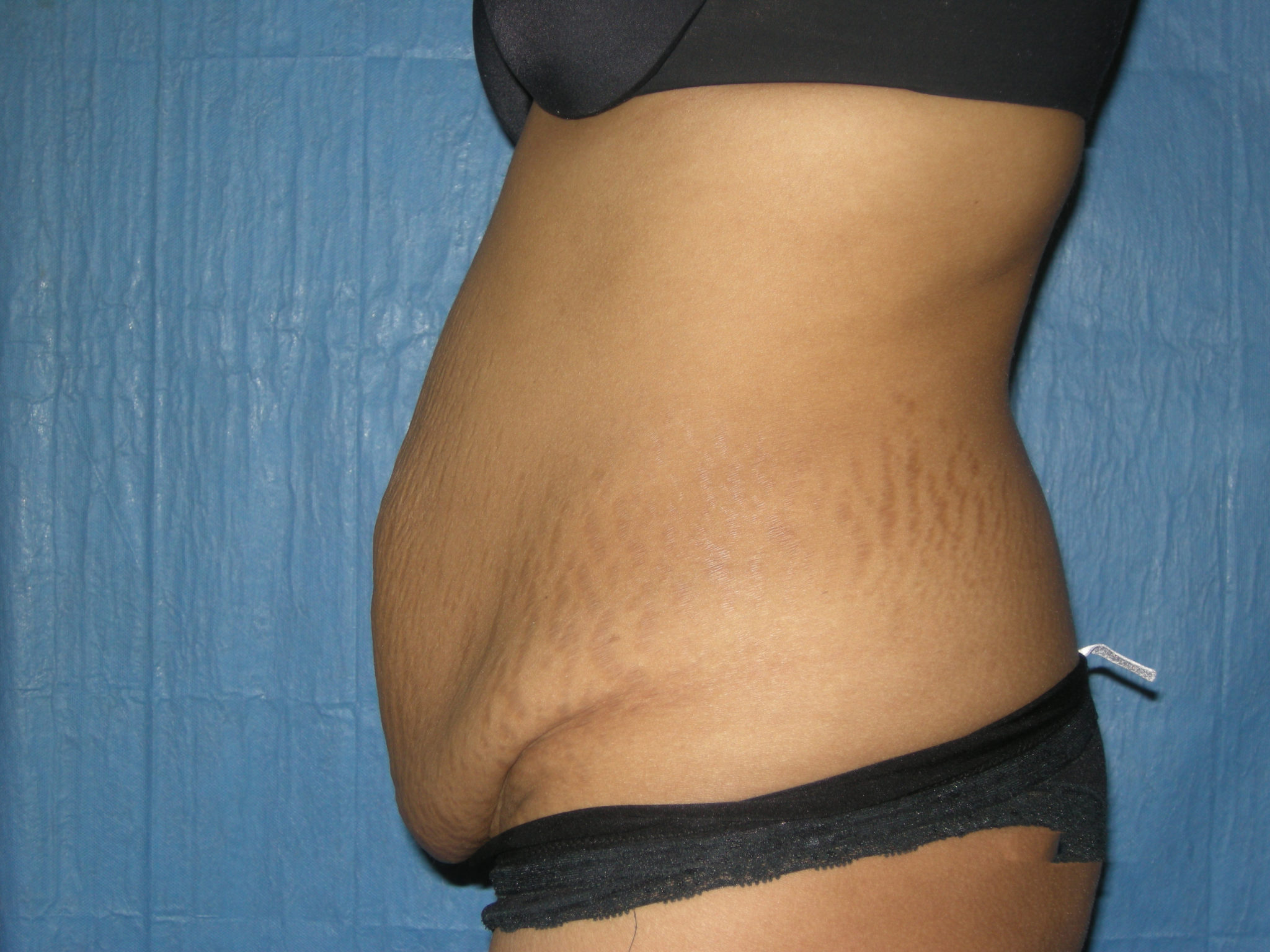 Tummy Tuck Patient Photo - Case 3465 - before view-1