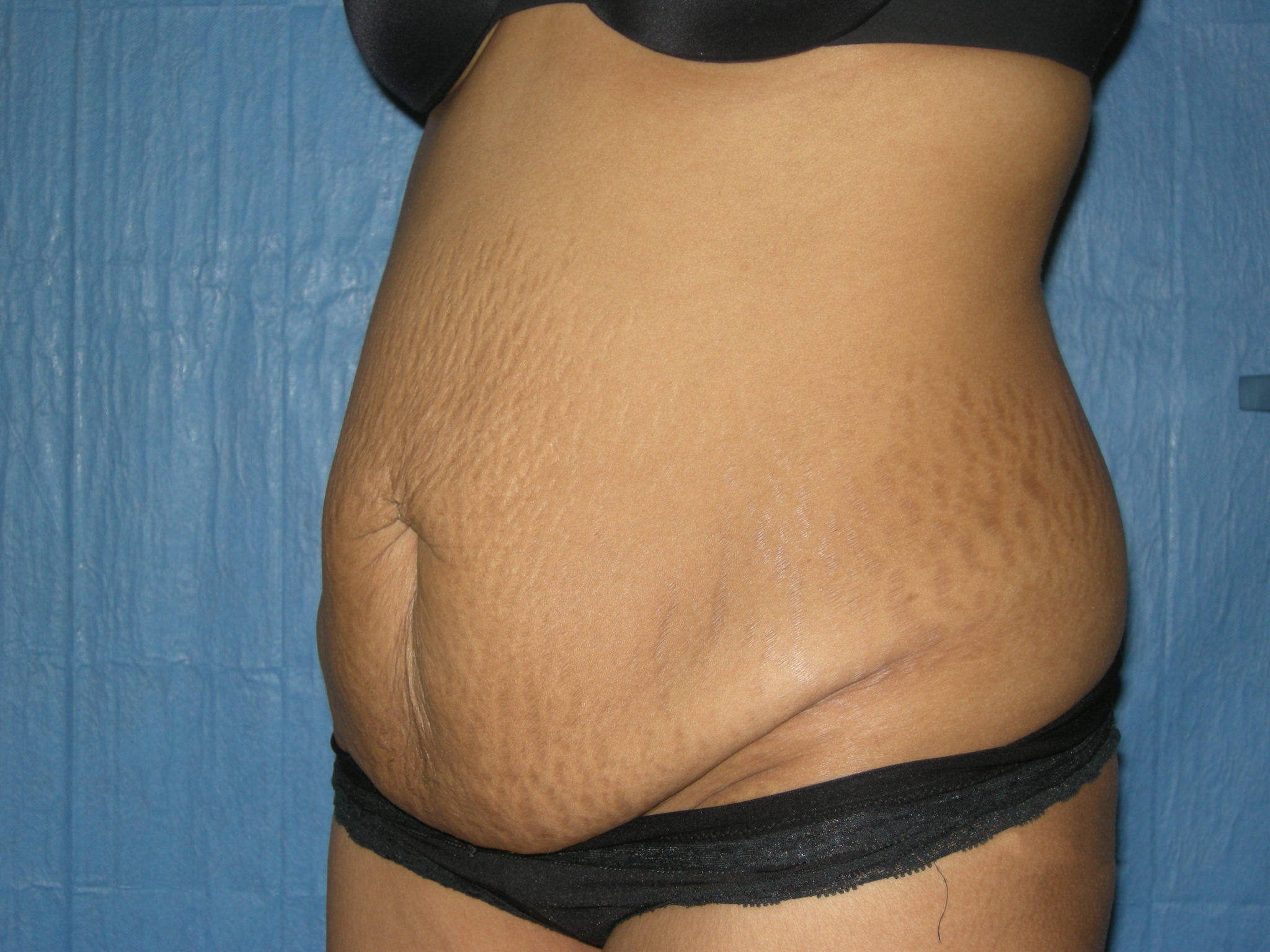 Tummy Tuck Patient Photo - Case 3465 - before view-2
