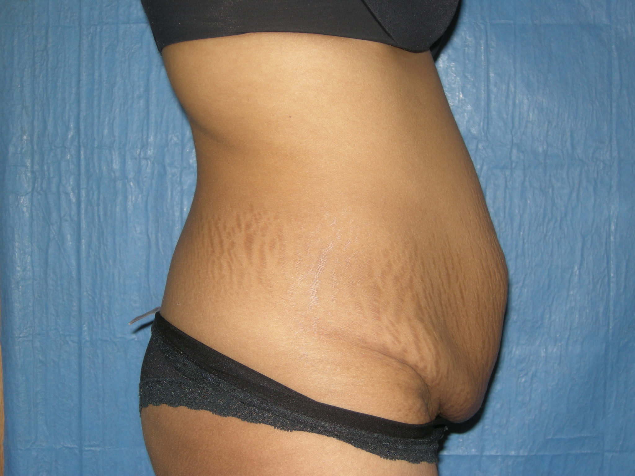 Tummy Tuck Patient Photo - Case 3465 - before view-3